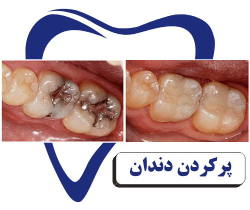 عکس قبل و بعد پر کردن دندان
