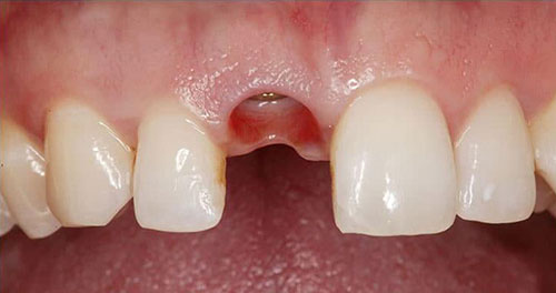 قبل ایمپلنت دندان