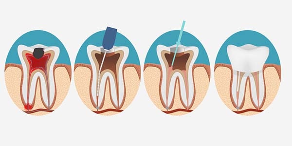 ترمیم کانال در عصب کشی مجدد دندان