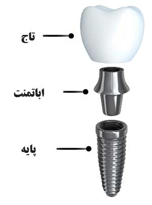 اجزاء ایمپلنت دندان