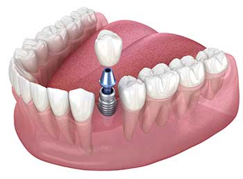 جایگزینی یک دندان با ایمپلنت