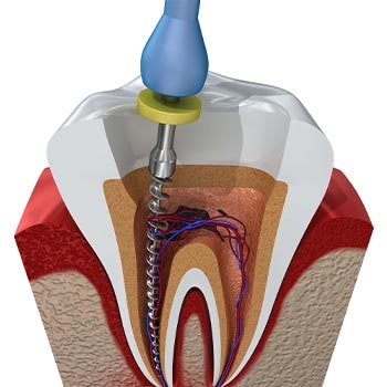 دکتر درمان ریشه دندان چطور عصب کشی را انجام می‌دهد؟