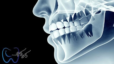 تاثیر استخوان فک روی درد بعد از کشیدن دندان
