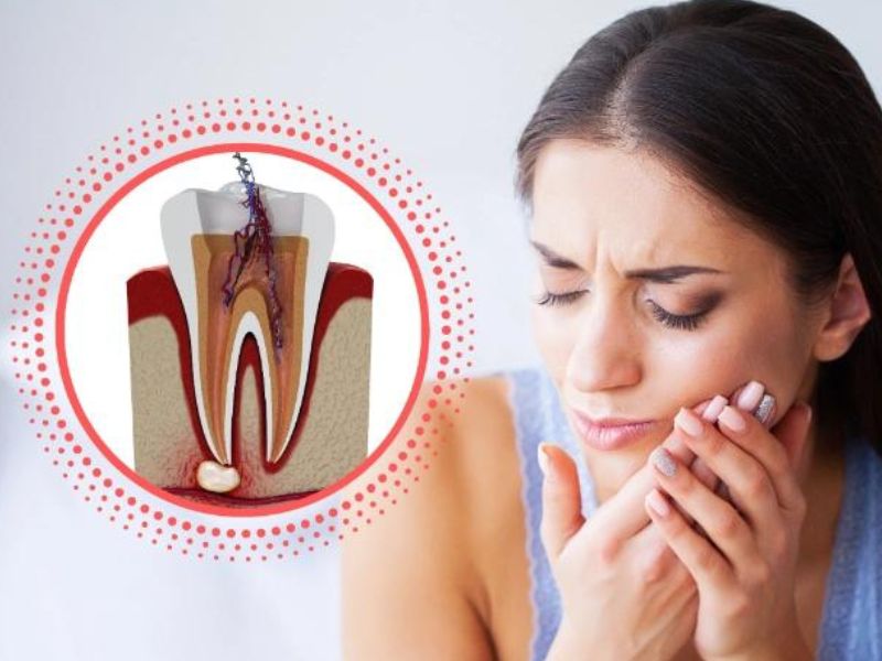 دندان درد بعد از عصب کشی