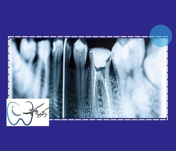 مدت زمان و تعداد جلسات عصب کشی دندان