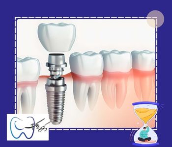 عوامل تاثیرگذار در مدت زمان ایمپلنت دندان