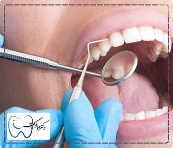 لیست مراقبت های بعد از روکش دندان