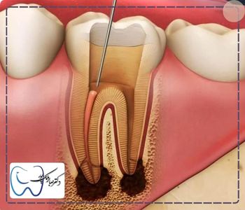 دوام دندان عصب کشی شده