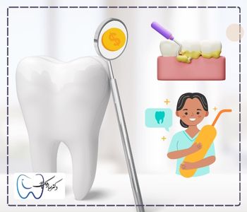 عوامل موثر در هزینه جرم گیری دندان
