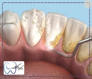 مدت زمان جرم گیری دندان
