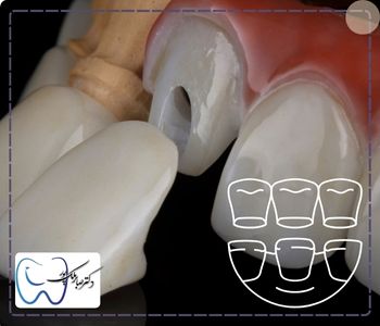 مراحل انجام روکش دندان عصب کشی شده