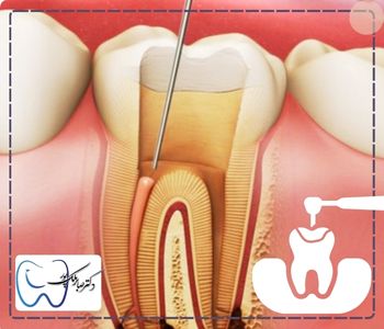 پر کردن دندان بعد از عصب کشی 