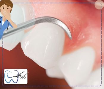 بهترین زمان جرم گیری دندان چه موقعی است؟