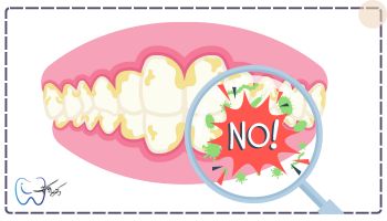 بروز عوارض جرم گیری دندان طبیعی است؟