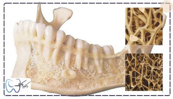 عوارض ایمپلنت بیماران مبتلا به پوکی استخوان از جمله استئونکروز