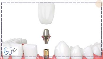 کاشت ایمپلنت 1 تا 2 ماه بعد از کشیدن دندان