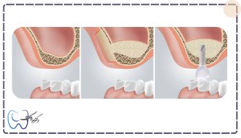 مشکلات ایمپلنت افراد مبتلا به پوکی استخوان از جمله کاهش تراکم استخوان فک