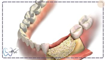 مشکلات ایمپلنت بیماران مبتلا به پوکی استخوان از جمله نیاز به پیوند استخوان