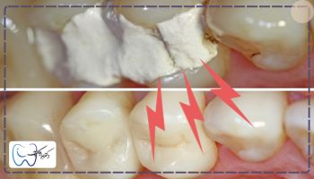 درد طبیعی برای علت درد دندان پانسمان شده 