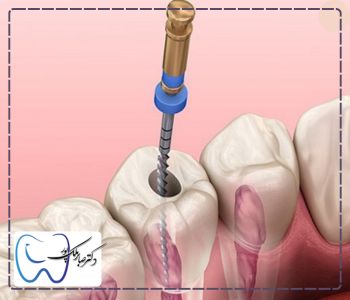 آبسه دندان را چگونه درمان کنیم؟