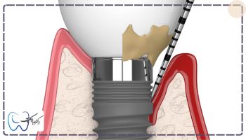 بوی بد دهان بعد از ایمپلنت به دلیل شکست درمان