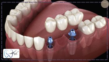 فاصله بین کشیدن دندان تا ایمپلنت کردن چقدر باید باشد؟