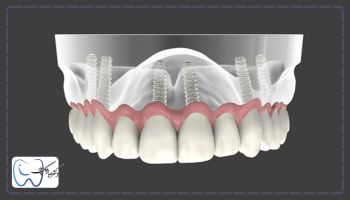 روکش تمام سرامیک از انواع روکش ایمپلنت دندان