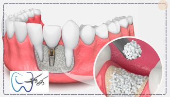 پیوند پودر استخوان برای ایمپلنت