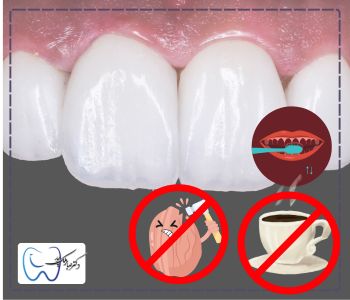 مراقبت‌ های بعد از روکش دندان جلو