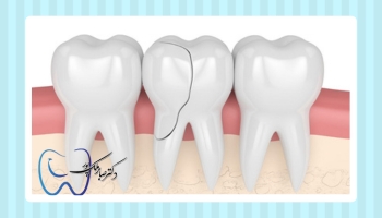 عواقب عصب کشی نکردن دندان