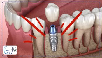 وارد شدن ضربه به ایمپلنت دلیل شکست ایمپلنت دندان