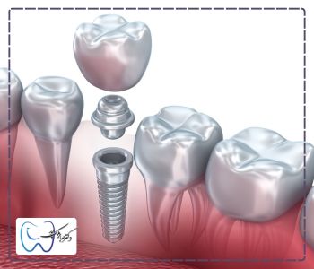 روکش فلزی از انواع تاج ایمپلنت دندان