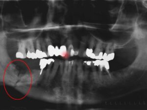 استئونکروز فک