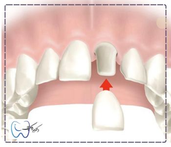قرارگیری روکش روی دندان برای روکش دندان