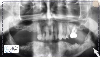 بیرون زدگی استخوان فک بعد از کشیدن دندان 
