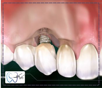 علائم پس زدن ایمپلنت دندان