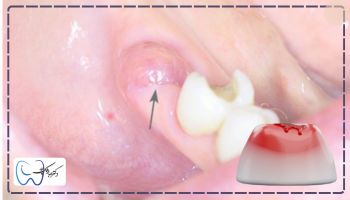 علائم بیرون زدگی استخوان فک بعد از کشیدن دندان مانند التهاب لثه
