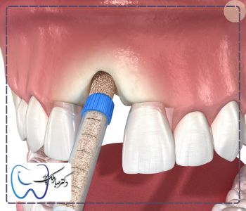 مقدار پودر استخوان برای ایمپلنت دندان