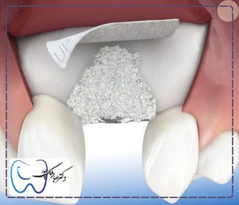 بهترین نوع پودر استخوان