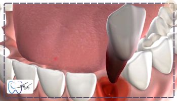 علت بیرون زدگی استخوان فک بعد از کشیدن دندان

