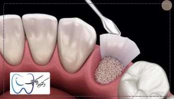 قیمت پودر استخوان برای ایمپلنت