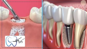 انواع پودر استخوان برای ایمپلنت