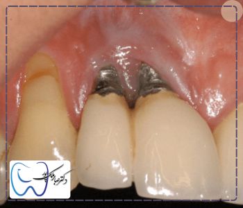 علت عفونت بعد از ایمپلنت دندان