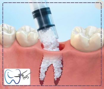 پودر استخوان ایمپلنت چیست؟