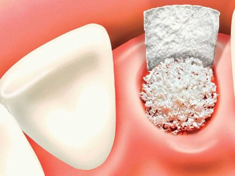پیوند استخوان ایمپلنت | پودر استخوان برای ایمپلنت