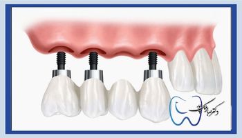 مزایای بریج دندانی بر پایه ایمپلنت
