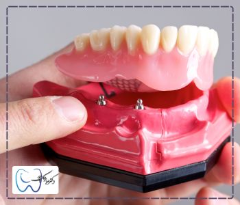 دندان مصنوعی بر پایه ایمپلنت