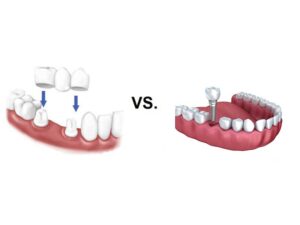 مقایسه تفاوت بریج و ایمپلنت