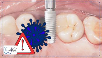 عوارض ایمپلنت چند دندان کنار هم