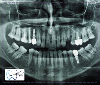 تهیه تصاویر رادیوگرافی در کاشت دندان مصنوعی بر پایه ایمپلنت
